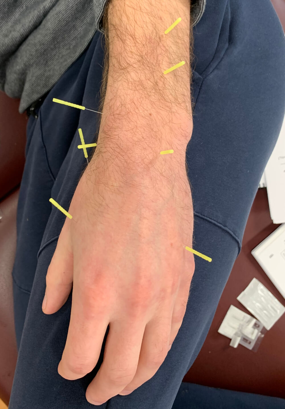 What is Dry Needling?